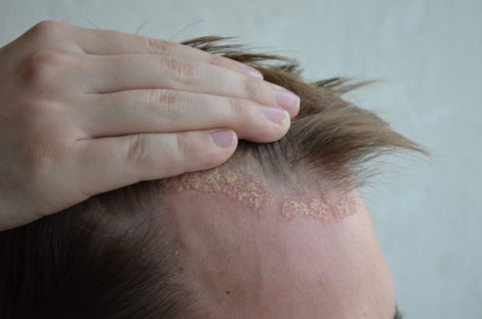 Dupixent treatment for atopic dermatitis"